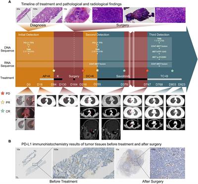 Joint DNA-RNA-based NGS for diagnosis and treatment of a rare CD47-MET fusion lung adenocarcinoma which was immunoresistant and savoltinib-sensitive: a case report